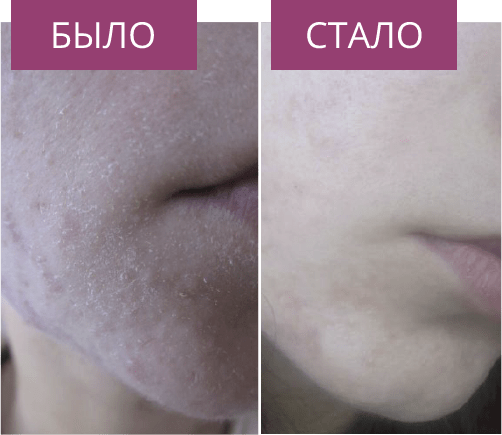 Девушка 23 года, сильная обезвоженность кожи, до и после